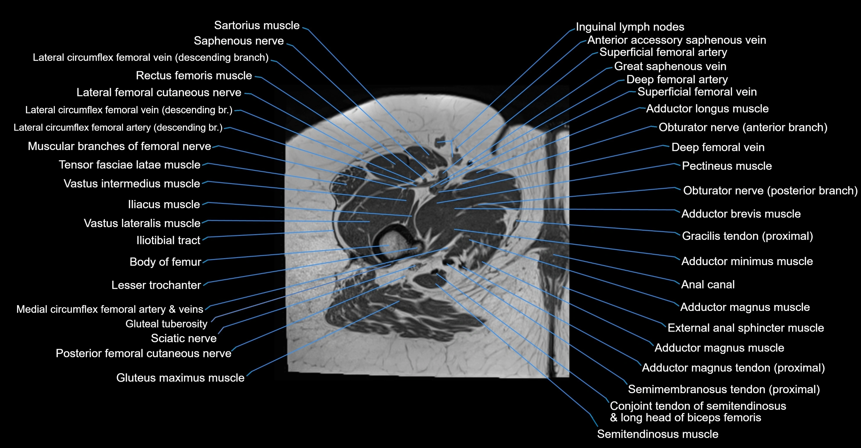MRI hip axial cross sectional anatomy 3T 3D  radiology  anatomy image-img-00001-00074.webp